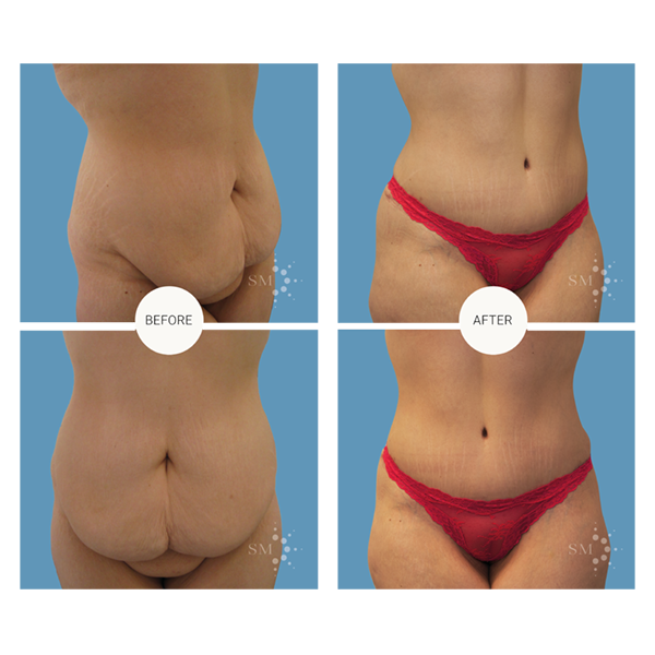 Quelle gaine pour ma liposuccion ou abdominoplastie ? - Clinique equilibre  abdominoplastie