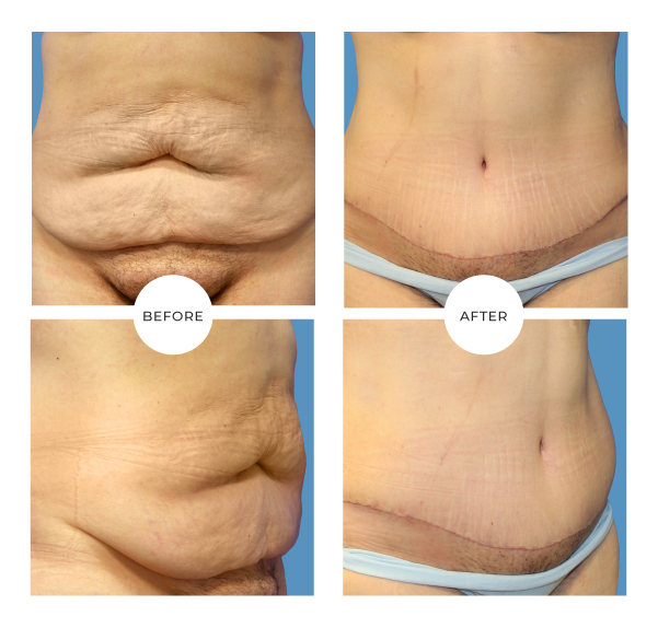 Tummy tuck in Montreal