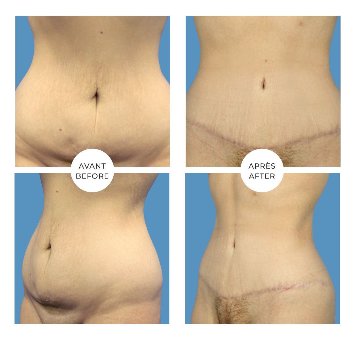 Bande Abdominale  Pour Abdominoplastie - Liposuccion - 9 po