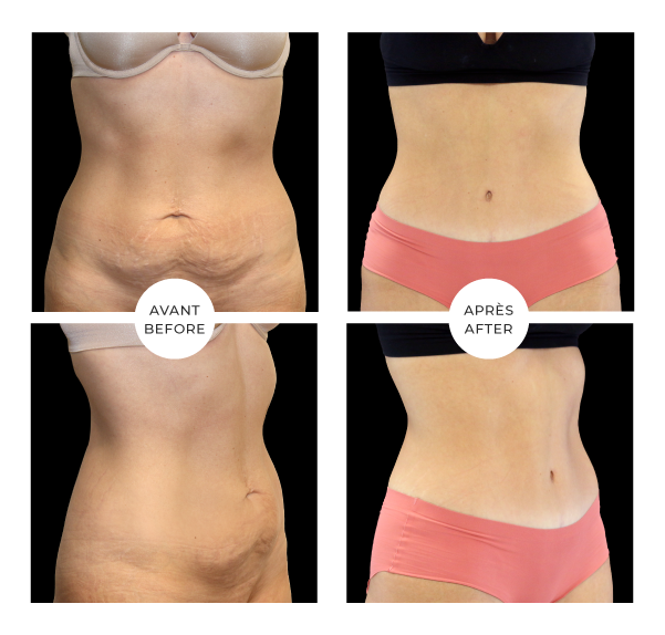 Gaine Après Abdominoplastie